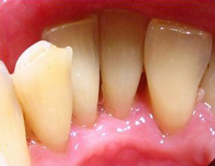 Результаты. Профессиональная гигиена в стоматологии "Ле Дент"