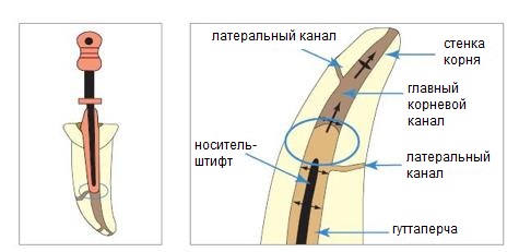 Горячая гуттаперча может вносится в корневой канал на специальном пластиковом штифте (система пломбировки «OneStep Obturator»)