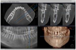 Пример компьютерной томографии зубов