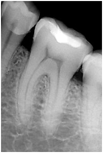 Прицельный снимок (одного зуба) в стоматологии "Ле Дент"