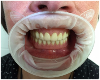 Пример подобного вида протезирования с опорой на имплантаты, проведенного командой стоматологической клиники 