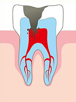 воспаление пульпы зуба