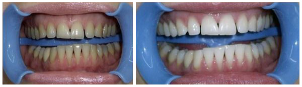 Результат после процедуры отбеливания системой «Beyond» в стоматологии "Ле Дент"