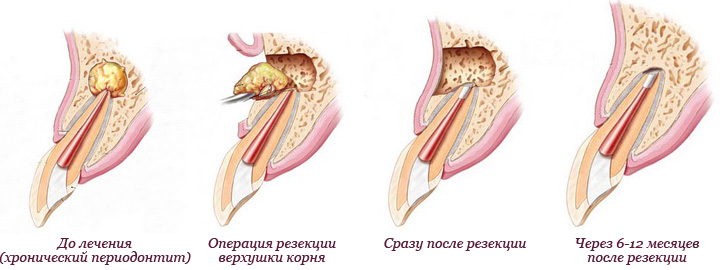 Резекция верхушки корня зуба